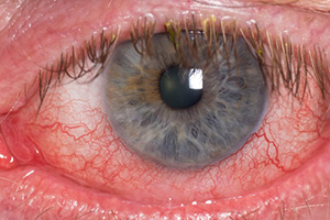 Retinal Circulatory Problems condition treated by Teton Retinal Institute