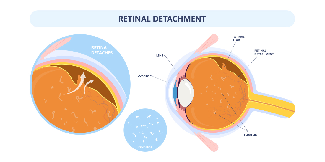 What Is Retinal Detachment? Symptoms, Causes, Risks and Treatments