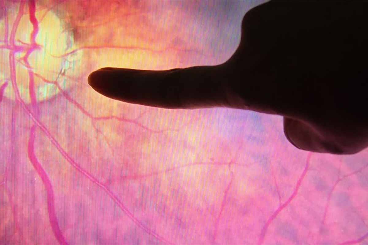 Diabetic Retinopathy condition treated by Teton Retinal Institute