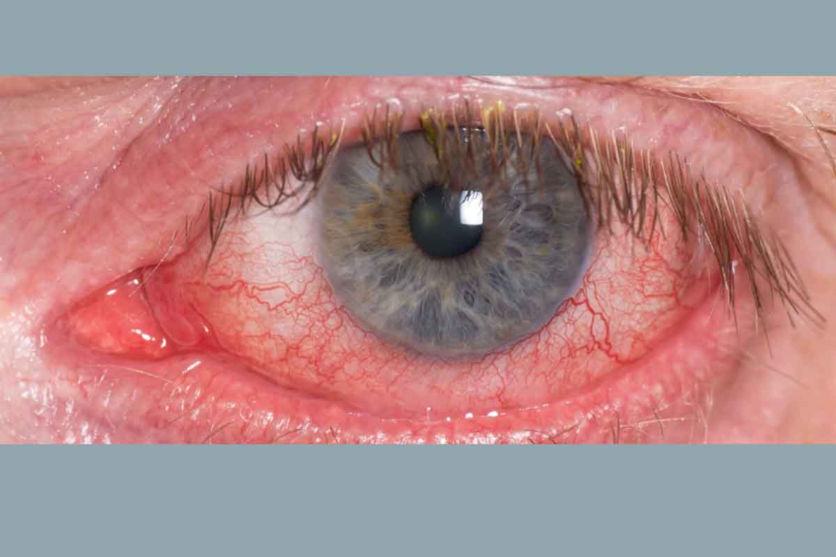 Retinal Circulatory Problems condition treated by Teton Retinal Institute